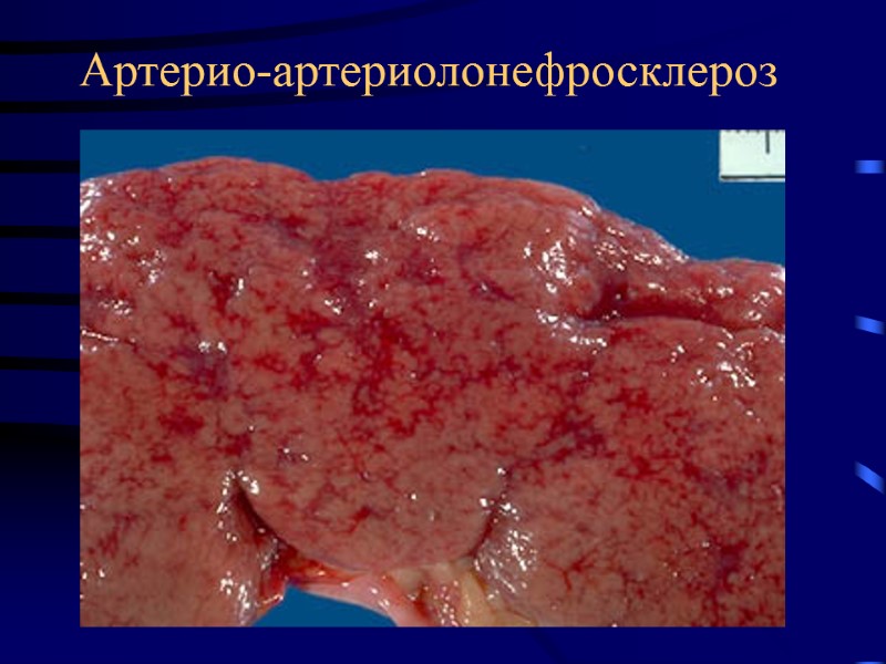 Артерио-артериолонефросклероз